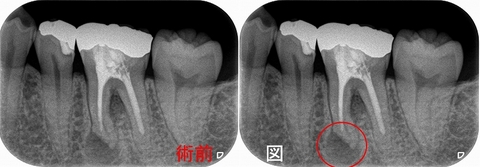 死腔があっても普通に治る根尖病変 - EE DENTAL_Blog